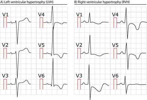 right ventricular hypertrophy vs left.